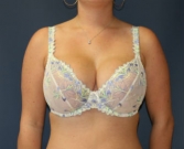 Feel Beautiful - Breast Augmentation San Diego Case 52a - After Photo